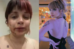 Sevgilisi tərəfindən tanınmaz hala salındı - Səbəbi sosial medianı ayağa qaldırdı - VİDEO